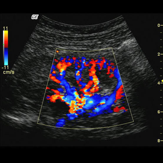 Color Doppler